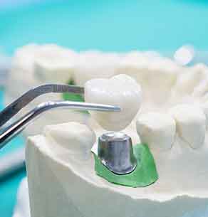dental bridge specialists