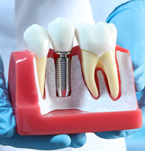 Dental implant consultant