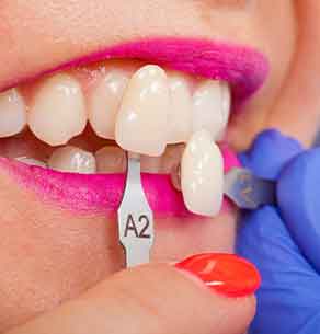 Affordable dental veneers