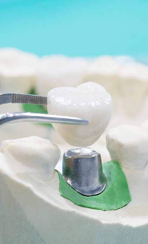 dental bridge specialists