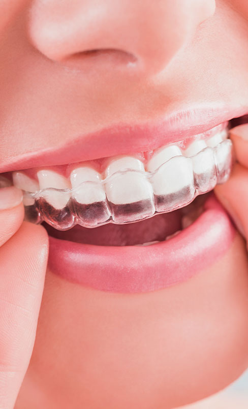 Best Quality Invisible Braces Near Me