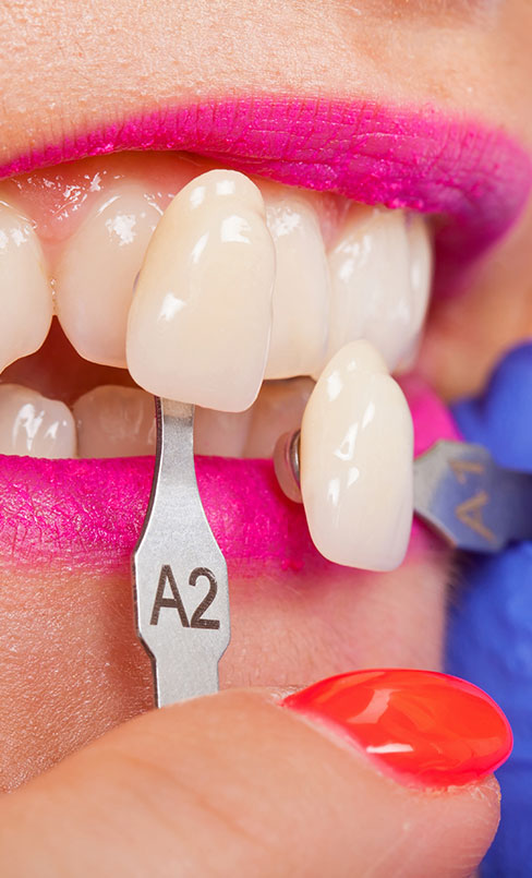 Affordable dental veneers