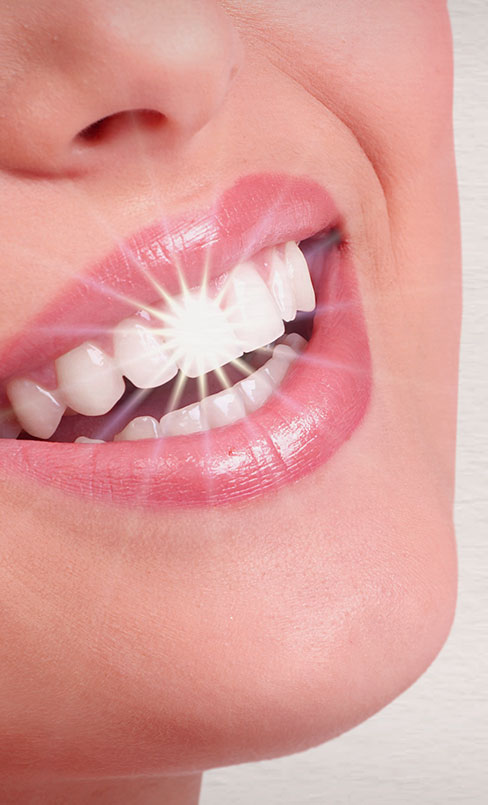 teeth whitening in Aldershot